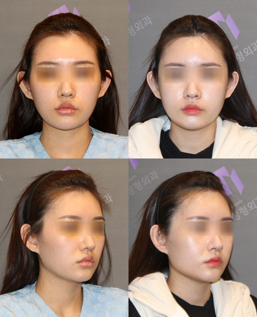 '230도입체광대축소술'에 대한 구체적인 설명  |  입체성형외과 조현우원장 관련 이미지 6