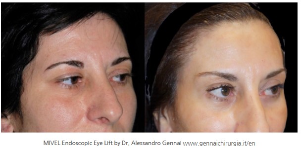 How Far Should Forehead Lift Dissection Go? Is More Fixation Always Better? image 6