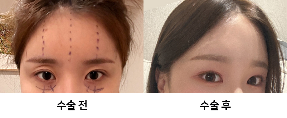 Endoscopic Forehead Lift Swelling and Recovery Time: Looking at It with Before-and-After Photos image 9