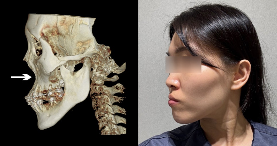 How Can a Sunken Midface Be Corrected? image 2