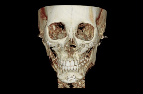 How Much Effect Does 230-Degree Zygoma Reduction Surgery Have? image 7