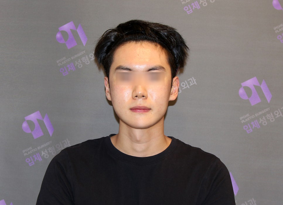 Male Facial Contouring (Zygoma Surgery, Square Jaw Surgery, Chin Surgery) - Explained by a Specialist. image 3