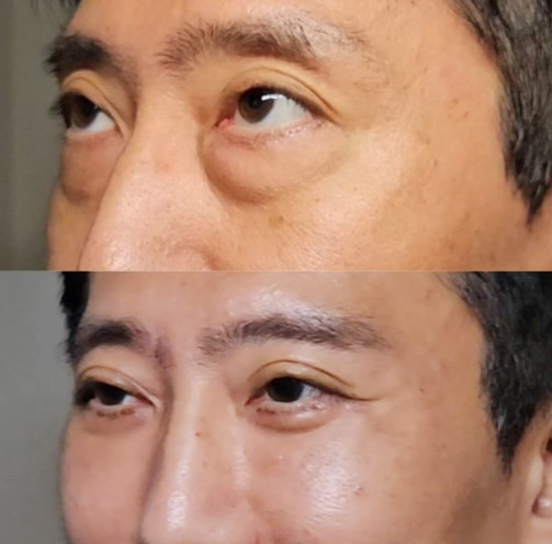 50대 남자눈성형 하안검 수술 케이스 - 세대별 분석으로 접근한 해결 전략 관련 이미지 6
