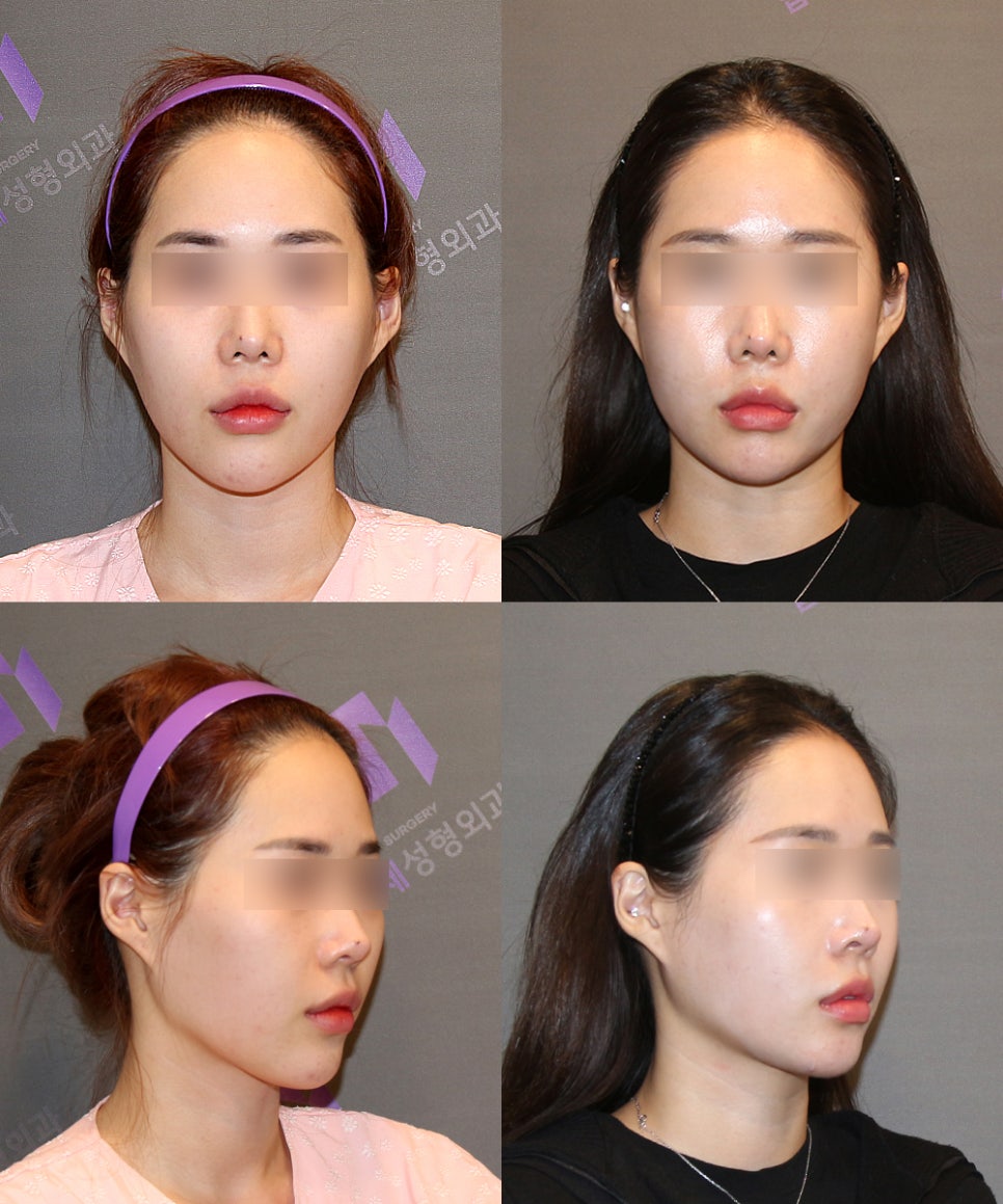Long Chin, Long Face Contouring - Cases That Do Not Require Double Jaw Surgery image 12