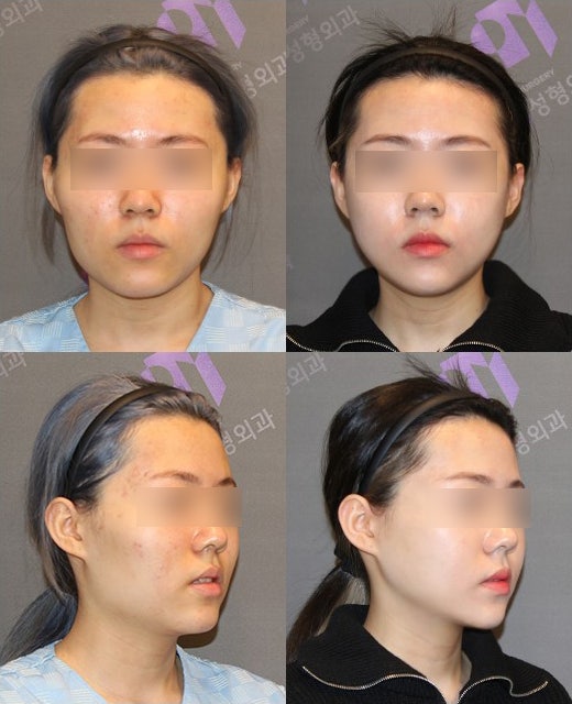 사각턱비대칭, 교근절제술(교근축소술)로 교정이 가능할까요? 관련 이미지 2