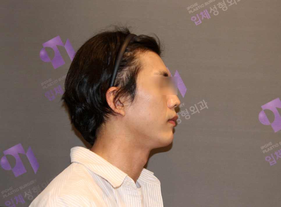 What Surgery Is Best for Correcting a Short Chin or Recessed Chin? The Limits of Chin Surgery and the Actual Results image 11