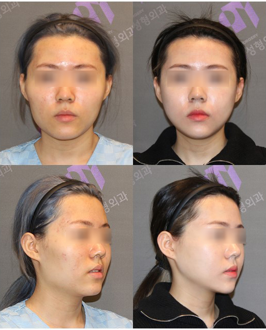 안면윤곽수술로 안면비대칭 교정할 수 있을까요? 관련 이미지 1