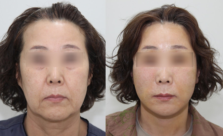 When Are Facial Contouring Surgery and Facelift Surgery Needed Together? image 8