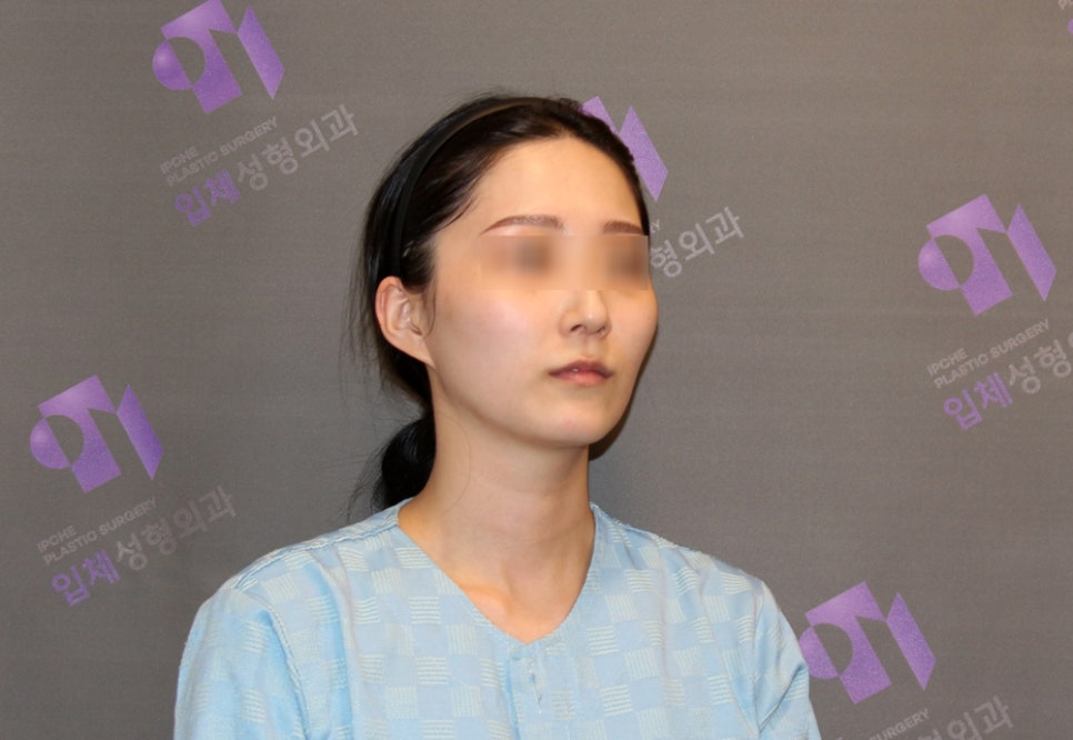 How Much Effect Does 230-Degree Three-Dimensional Zygomatic Reduction Have? image 5