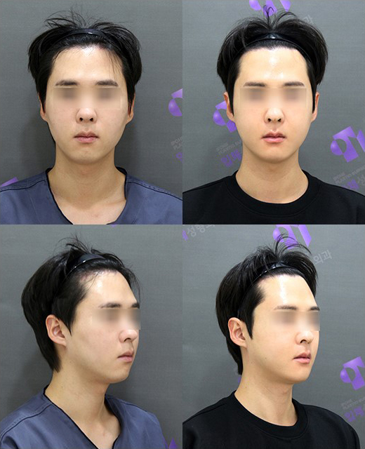 Facial Contouring A to Z: What Is Contouring Surgery? image 9