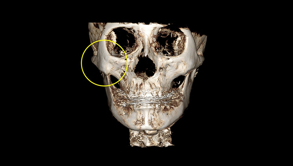 How Much Effect Does 230-Degree Three-Dimensional Zygomatic Reduction Have? image 3