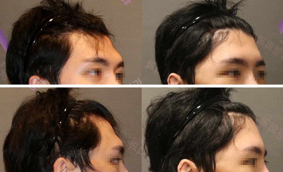 How Should Brow Bone Prominence Be Addressed? image 3