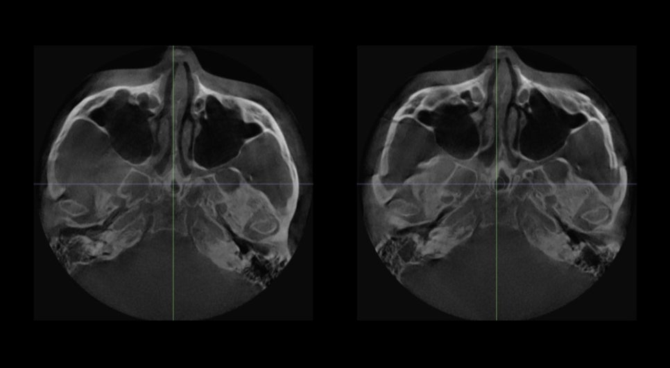 Non-fixation zygoma reduction surgery, will the bone heal properly? image 3