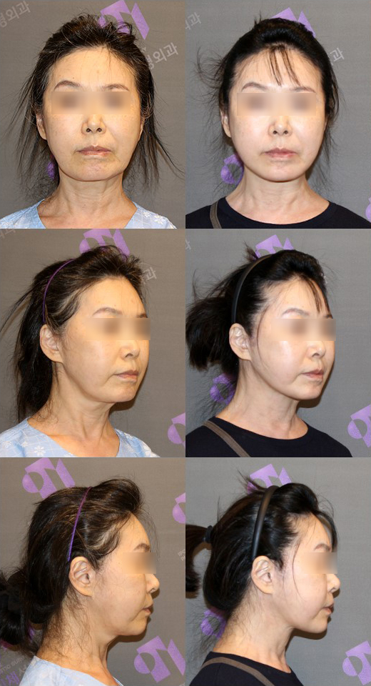 How Should Double Chin and Skin Sagging After Contouring Surgery Be Addressed? image 5