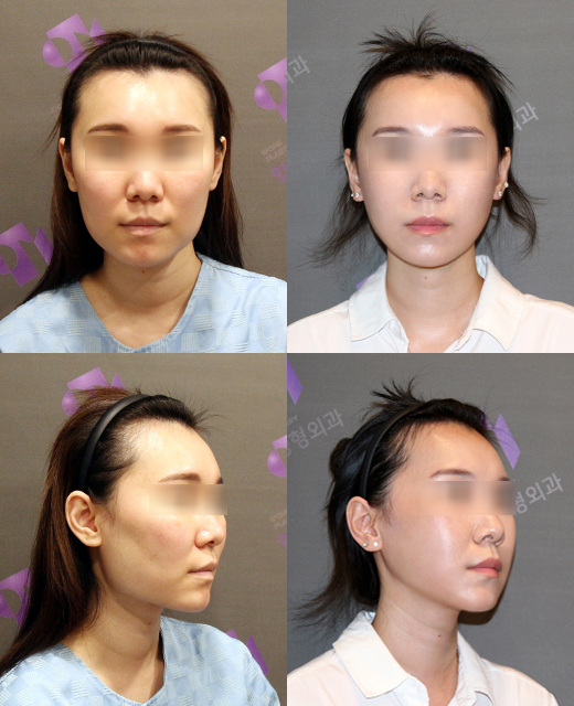 After zygoma reduction surgery, the cheek sagging is severe — is it because of dissection? image 5