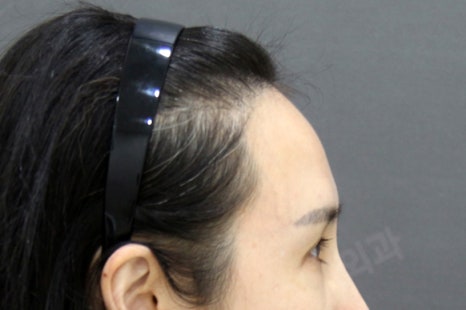 3D프린터 보형물을 이용한 안구함몰, 함몰눈 교정의 실제 사례 관련 이미지 2