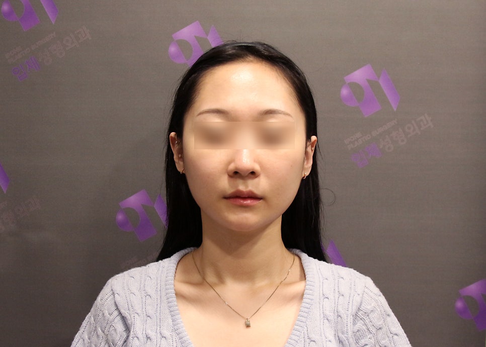안면윤곽 볼처짐 원인은 무엇인가요? (솔직한 생각) 관련 이미지 4
