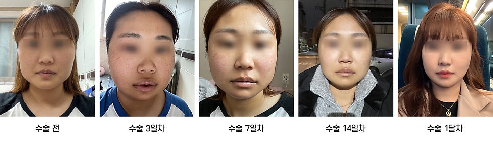 안면윤곽 수술 후 붓기, 일상생활은 언제부터 가능한가요? 케이스별로 알아보기 관련 이미지 7