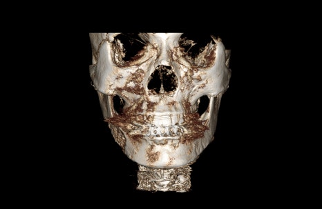 Are There People Who Can’t Have Cortical Ostectomy Surgery for a Frontal Square Jaw Effect? image 14