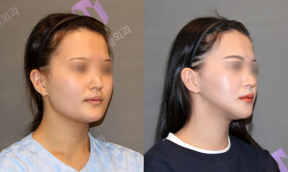 What Side Effects Can Occur Due to Excessive Reduction in Facial Contouring Surgery? image 4