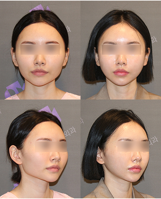땅콩형 얼굴은 어떻게 개선할 수 있을까요? 관련 이미지 3