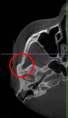Will cheekbone reduction surgery also make the face smaller? : Learn about how to reduce prominent cheekbones with real surgical cases image 2