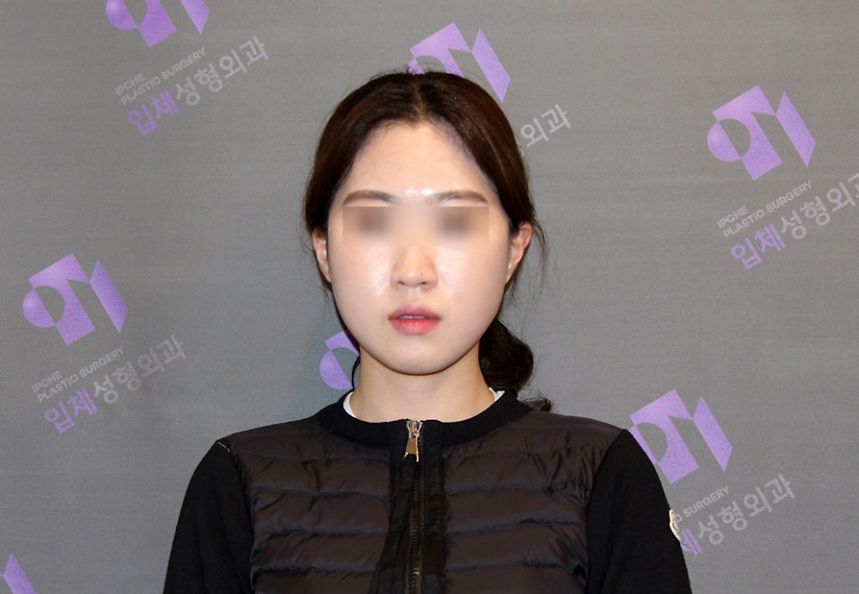 How Much Effect Does 230-Degree Three-Dimensional Zygomatic Reduction Have? image 12