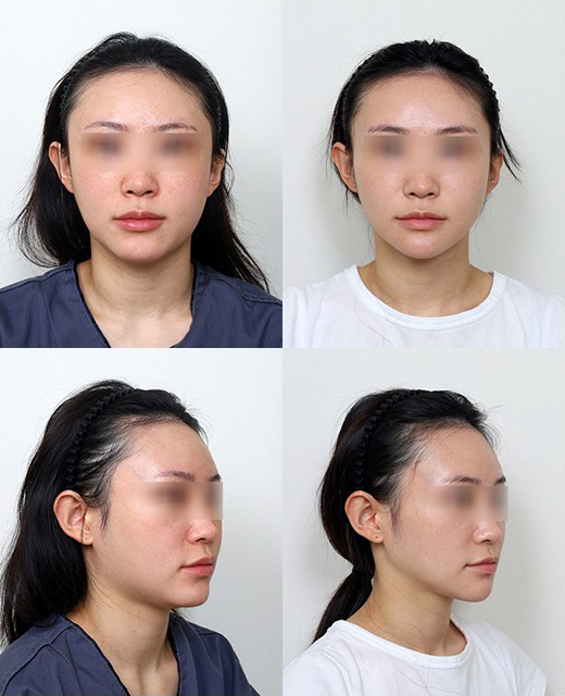 턱끝수술 종류 총정리, 전진술부터 뼈이식까지 관련 이미지 2