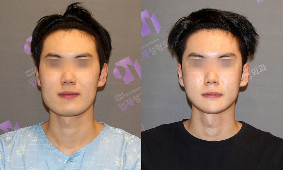Male Facial Contouring (Zygoma Surgery, Square Jaw Surgery, Chin Surgery) - Explained by a Specialist. image 4