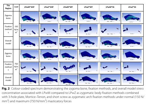 [Paper Review] What Matters More in Zygoma Reduction Than Double or Triple Fixation image 4
