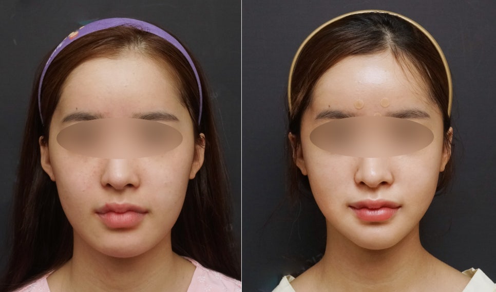 안면윤곽연예인, 연예인들은 왜 갈수록 예뻐질까요? - 성형외과 전문의가 직접알려드립니다. 관련 이미지 10
