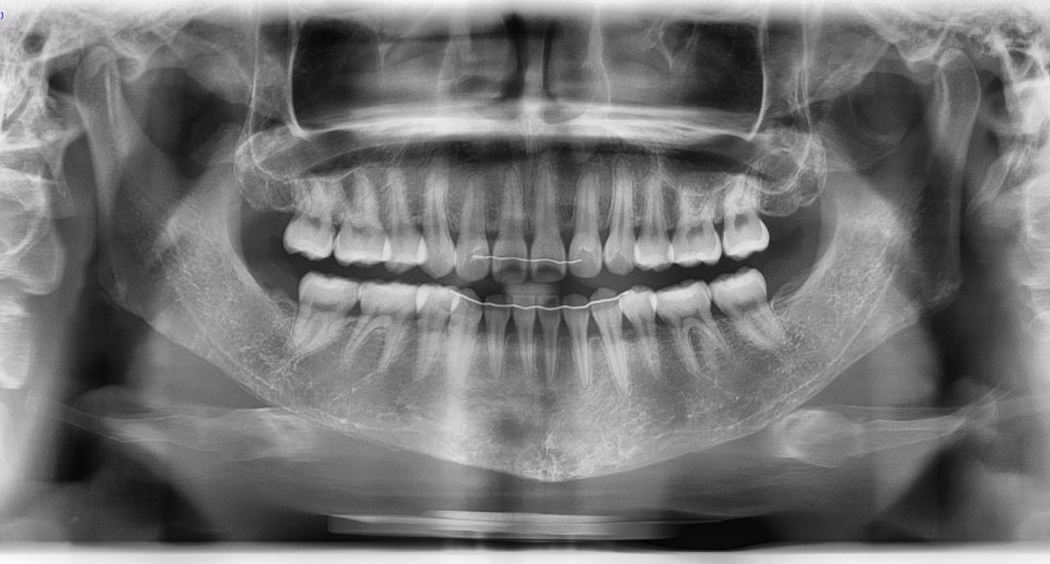 Long Chin, Long Face Contouring - Cases That Do Not Require Double Jaw Surgery image 10