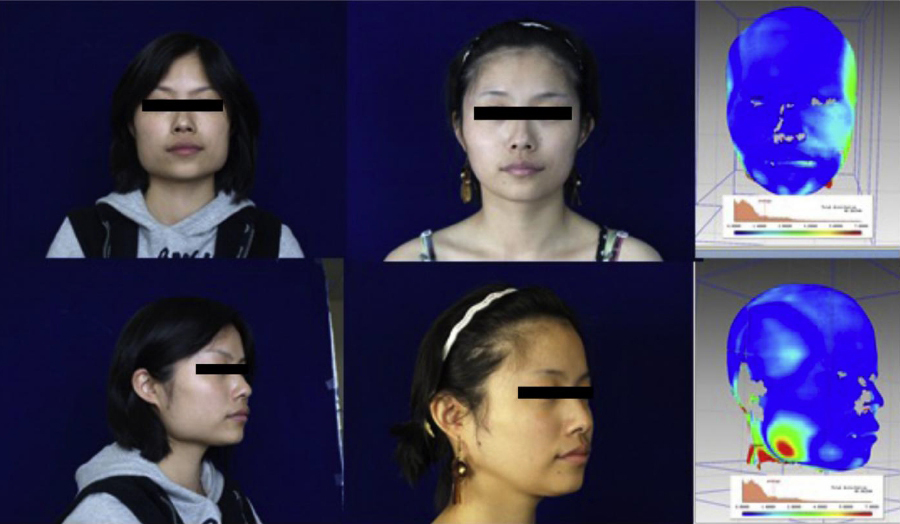 [논문 리뷰] 사각턱 뼈가 줄어들면 실제 내 얼굴은 얼마나 작아지나요? 관련 이미지 5