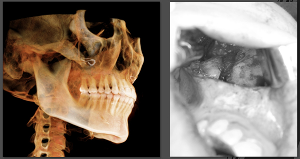 Non-fixation zygoma reduction surgery, will the bone heal properly? image 1