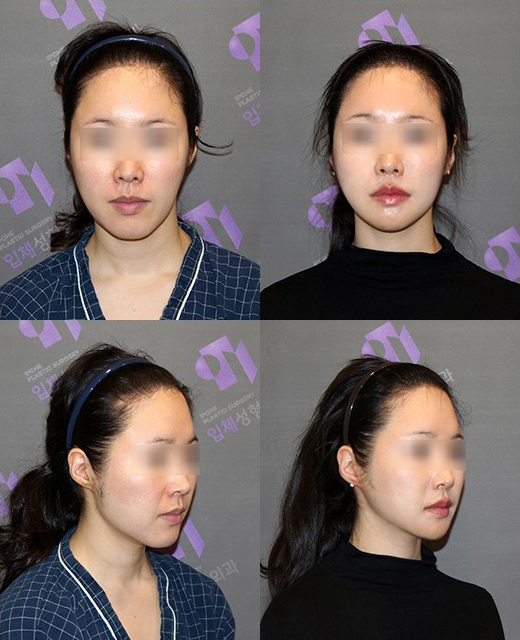 안면윤곽수술 후 신경손상 어떤 것이 있을까요? 관련 이미지 4
