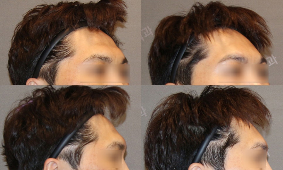 눈썹뼈돌출, 무조건 깎는 것이 답일까요? 눈썹뼈절삭부터 이마성형까지 관련 이미지 7