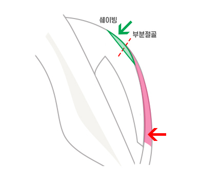 하이엘광대수술은 일반 광대축소술과 어떻게 다른가요? 관련 이미지 7