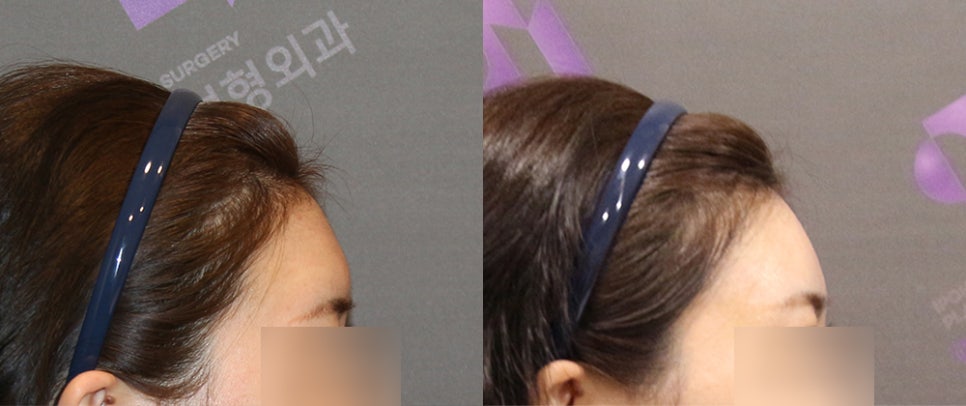 Forehead Fat Grafting Side Effects: Is There a Way to Remove Excess Fat? image 12