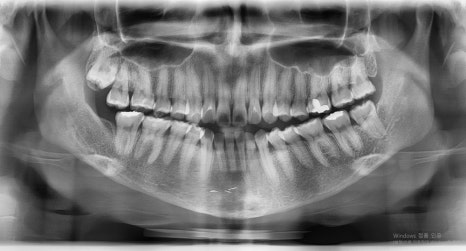Which Surgery Do I Need: Contouring Surgery or Double-Jaw Surgery? image 9