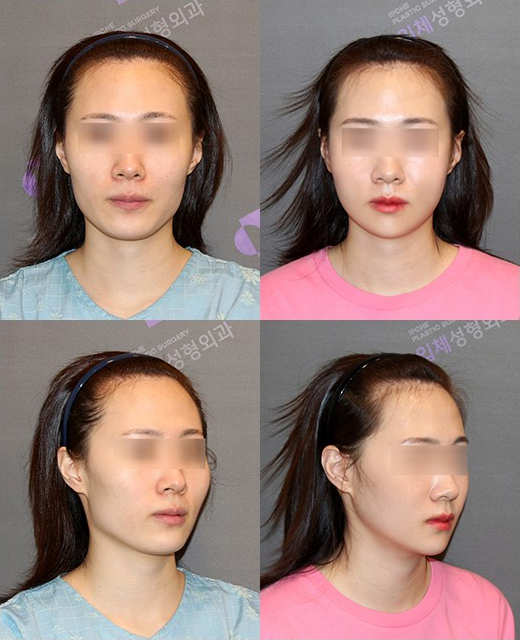 윤곽수술 후 피주머니 꼭 착용해야 하나요? 관련 이미지 6