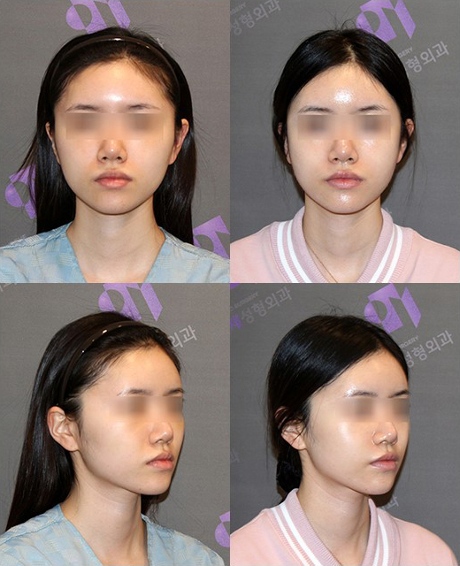 땅콩형얼굴 윤곽수술로 해결할 수 있을까요? 관련 이미지 3