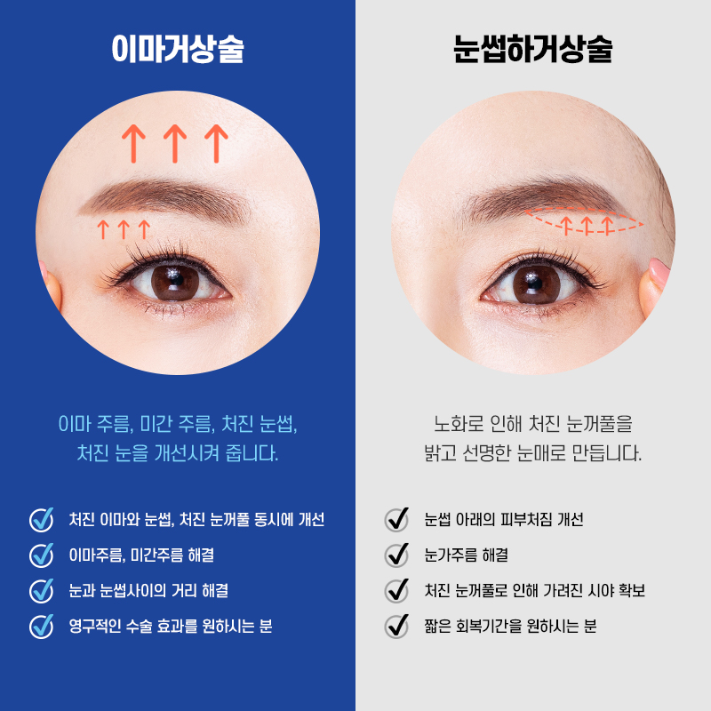 눈썹하거상술 vs 이마거상술 차이와 선택 방법 관련 이미지 6
