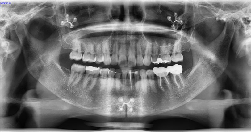 Is It Necessary to Remove the Fixation Pins After Facial Contouring Surgery? image 4