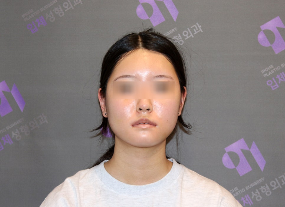 안면윤곽수술 후 붓기, 일차별(1일~30일차) 사진과 함께 회복기간 알아보기 관련 이미지 3