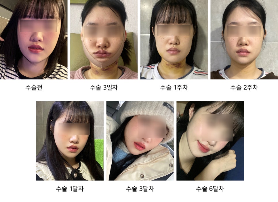 Eating, Exercise, and Swelling Management After Facial Contouring Surgery - Explained by a Specialist image 2