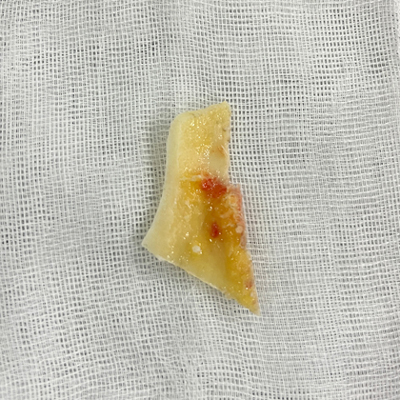 Are There People Who Can’t Have Cortical Ostectomy Surgery for a Frontal Square Jaw Effect? image 4