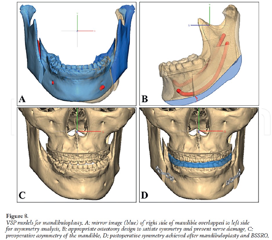 [Paper Review] Technological Advances and Real-World Applications in Modern Facial Contouring Surgery: Correction of Facial Asymmetry image 9