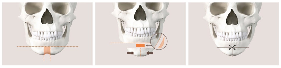 Why Are There So Many Different Chin Surgery Methods? Exploring Advancement, Setback, Reduction, and Lengthening image 9