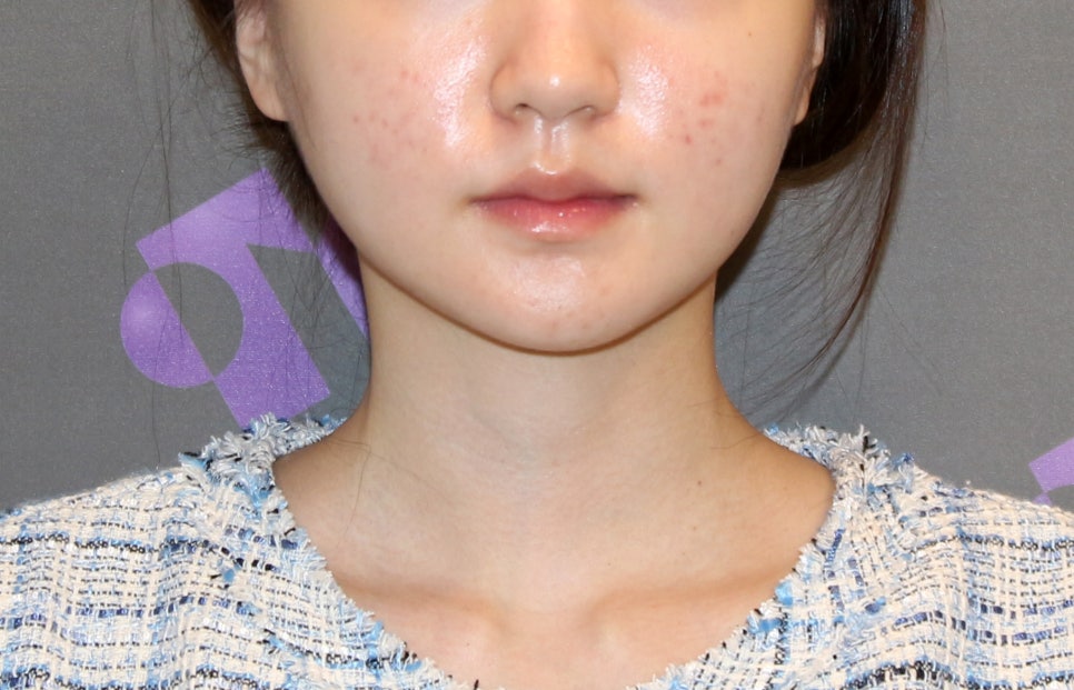 턱끝수술부작용, 이중턱이 생기는 이유는? - 전문의가 알려드립니다. 관련 이미지 7