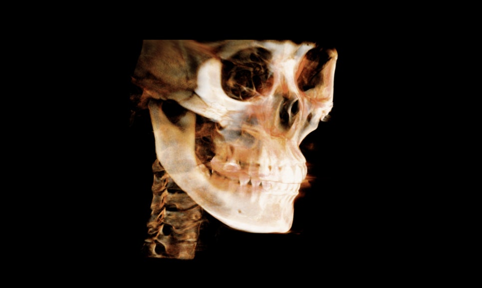 What Should Be the Top Priority in Facial Contouring Surgery: Effectiveness or Safety? image 2